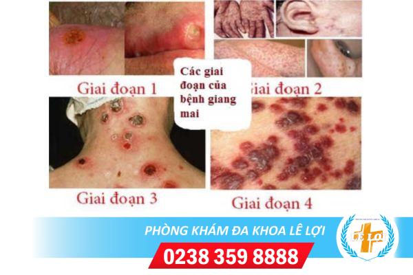 Địa chỉ khám giang mai bảo mật thông tin, điều trị phí thấp