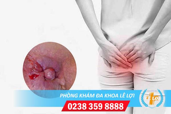 Cách chữa trị bệnh lậu ở hậu môn hiệu quả nhanh