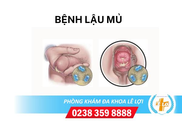 Lậu mủ là bệnh gì nguy hiểm không?