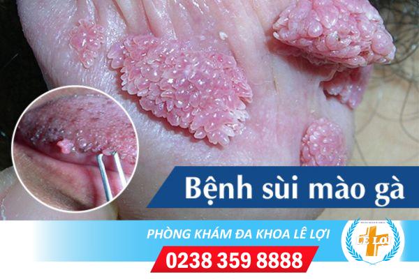 Địa chỉ chữa sùi mào gà hiệu quả, không đau, không tái phát