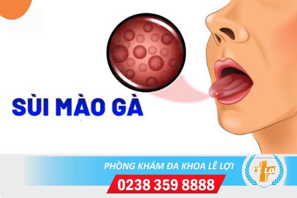 Chữa sùi mào gà ở đâu hiệu quả nhanh, phí thấp?