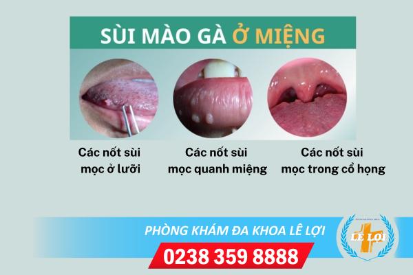 sui-mao-ga-o-mieng-trieu-chung