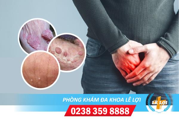 Cách trị sùi mào gà ở nam hiệu quả