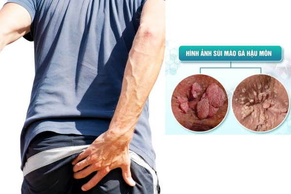 Một lần bất cẩn – cả đời ám ảnh với sùi mào gà hậu môn
